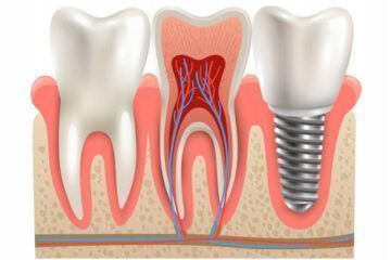 implante dentario em joinville